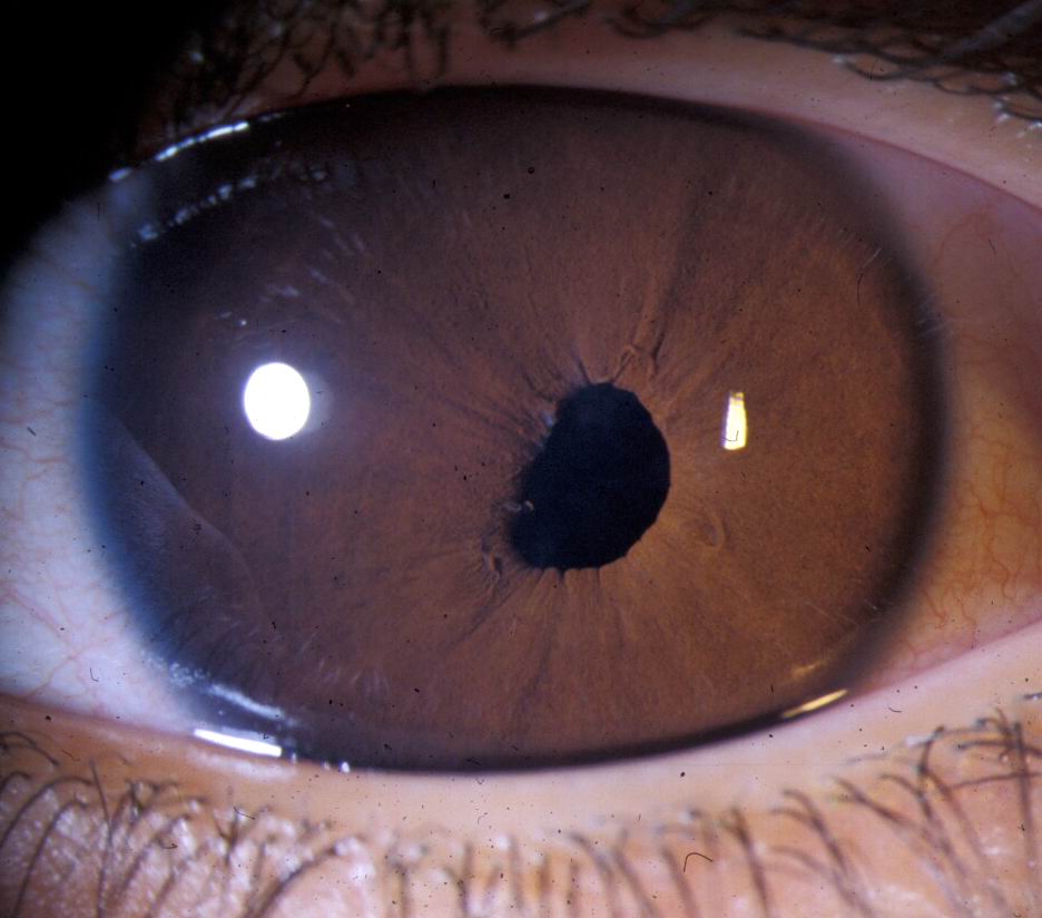 Ectopia Lentis et Pupillae Hereditary Ocular Diseases